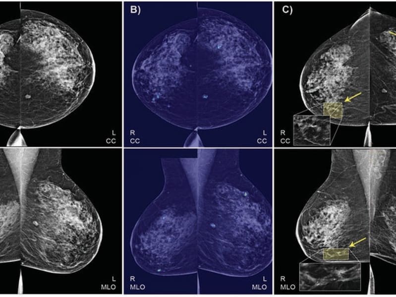 Nu samarbejde speciallægerne i radiologi sammen med kunstig intelligens om at finde brystkræft. Foto: IBM Research on Flickr.