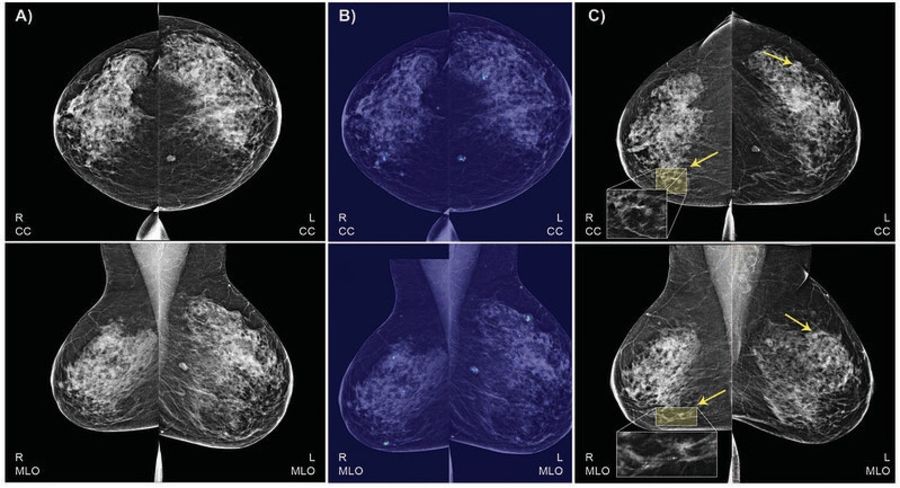Nu samarbejde speciallægerne i radiologi sammen med kunstig intelligens om at finde brystkræft. Foto: IBM Research on Flickr.